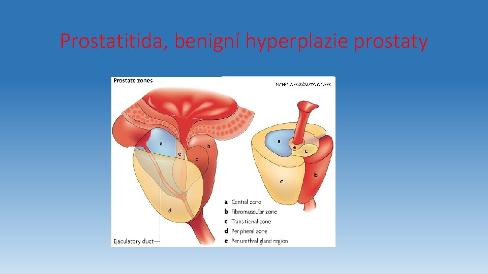 Prostatitida, benigní hyperplazie prostaty www. nature. com 