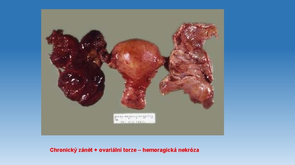 Chronický zánět + ovariální torze – hemoragická nekróza 