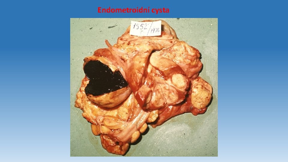 Endometroidní cysta 