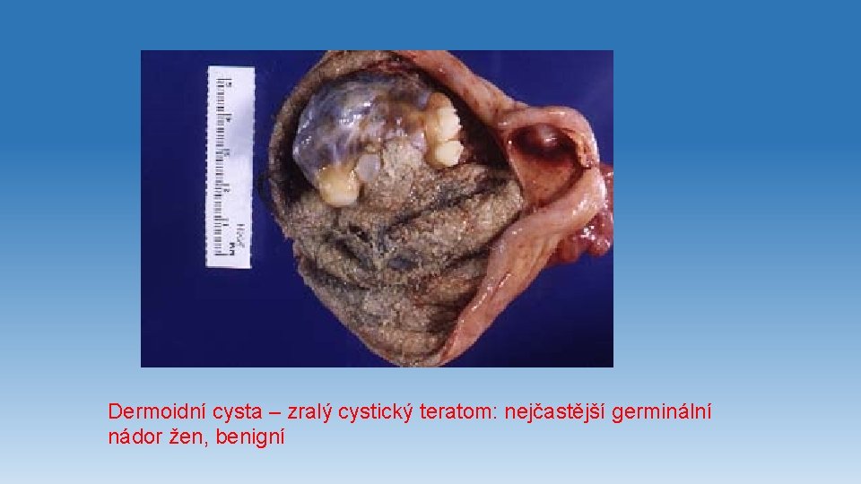 Dermoidní cysta – zralý cystický teratom: nejčastější germinální nádor žen, benigní 