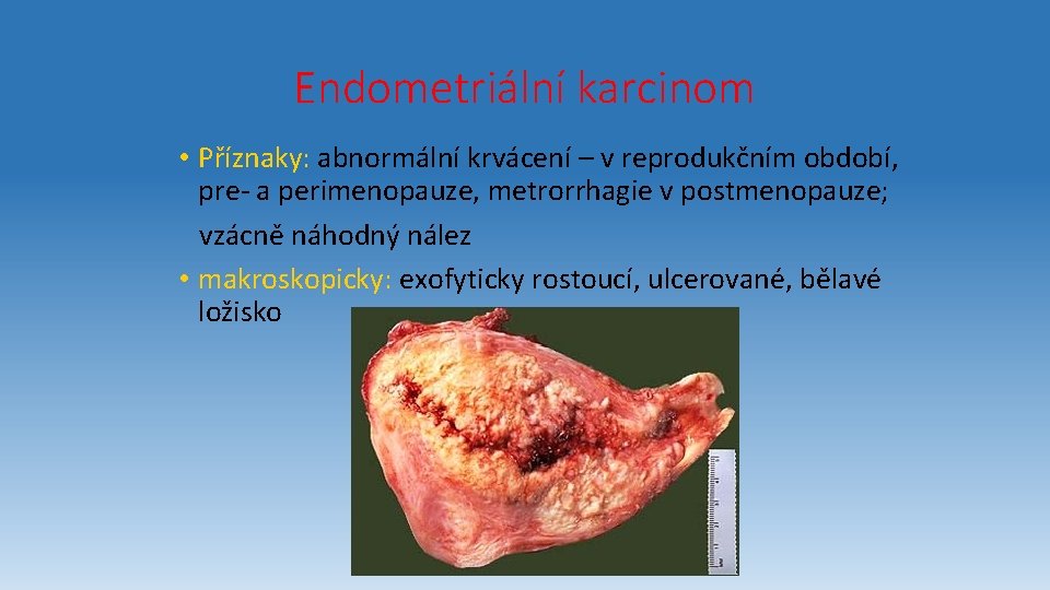 Endometriální karcinom • Příznaky: abnormální krvácení – v reprodukčním období, pre- a perimenopauze, metrorrhagie