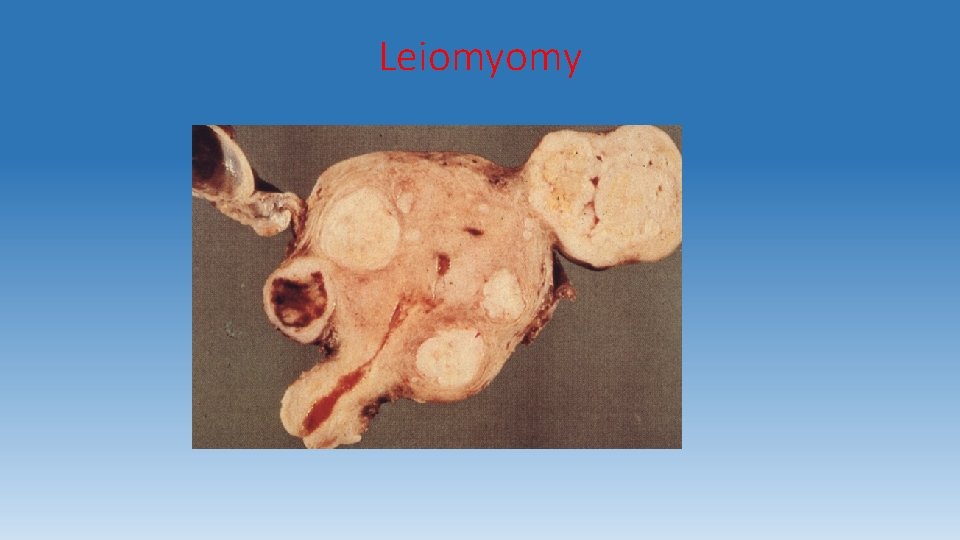 Leiomyomy 