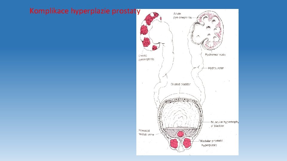 Komplikace hyperplazie prostaty 