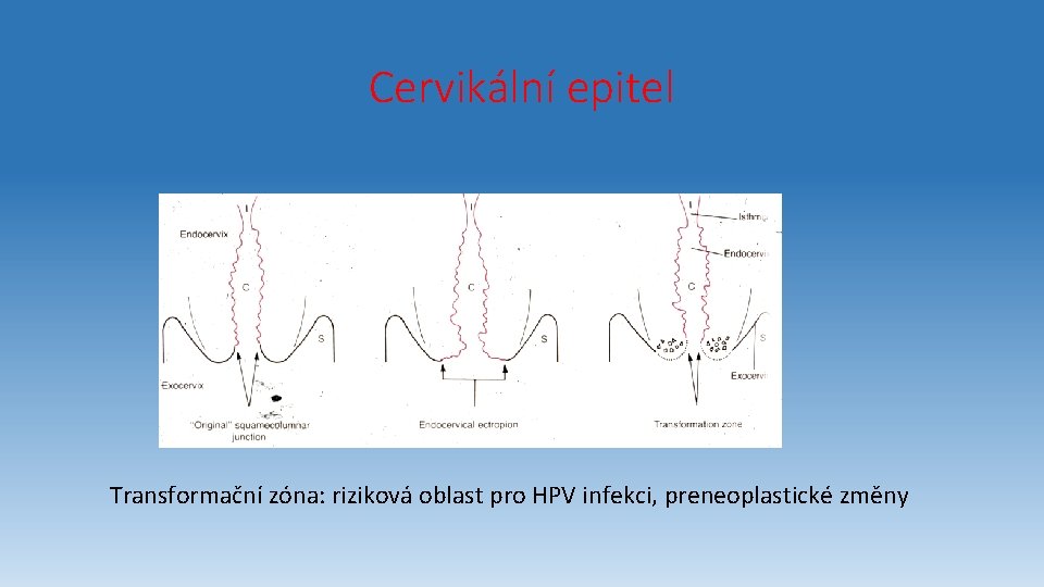 Cervikální epitel Transformační zóna: riziková oblast pro HPV infekci, preneoplastické změny 