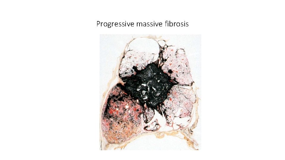 Progressive massive fibrosis 