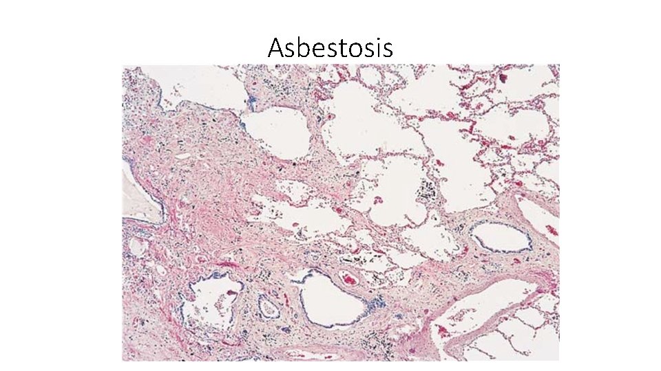 Asbestosis 