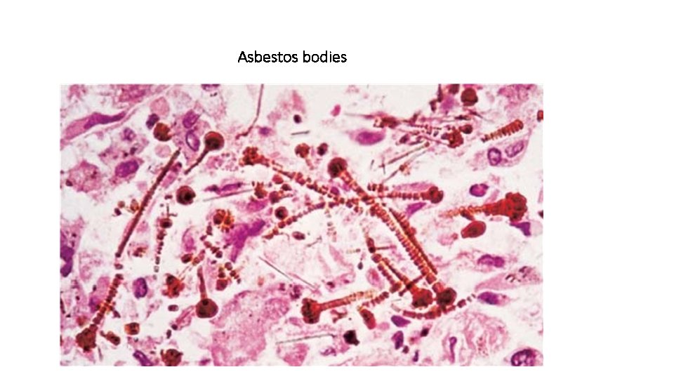 Asbestos bodies 