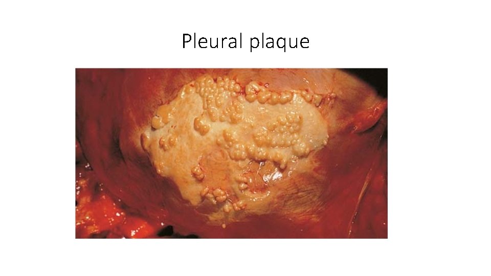 Pleural plaque 