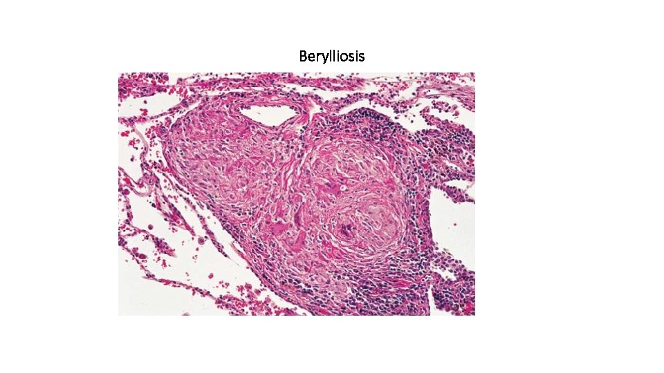 Berylliosis 