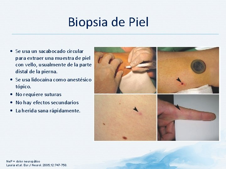 Biopsia de Piel • Se usa un sacabocado circular para extraer una muestra de