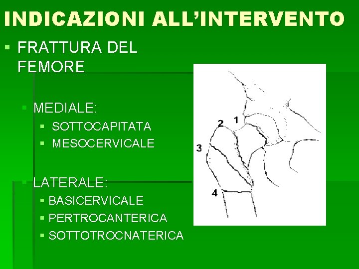 INDICAZIONI ALL’INTERVENTO § FRATTURA DEL FEMORE § MEDIALE: § SOTTOCAPITATA § MESOCERVICALE § LATERALE: