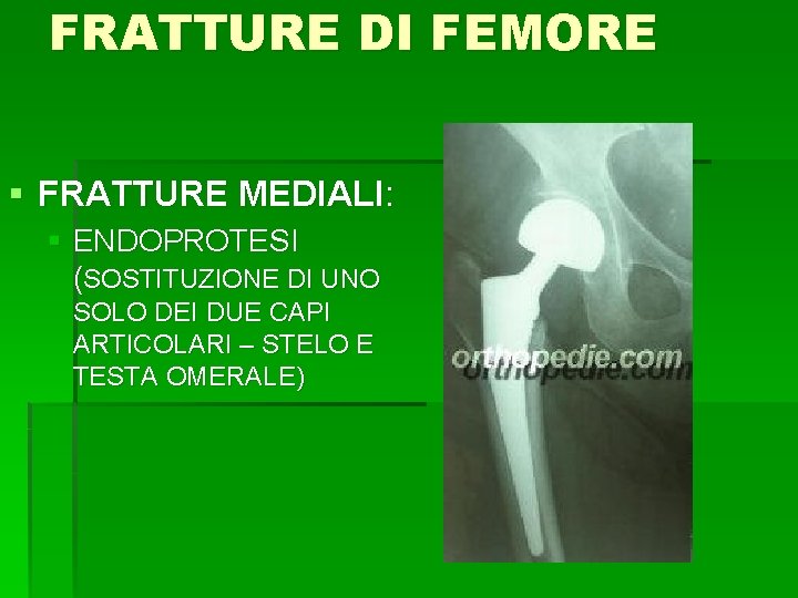 FRATTURE DI FEMORE § FRATTURE MEDIALI: § ENDOPROTESI (SOSTITUZIONE DI UNO SOLO DEI DUE