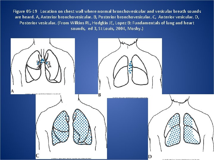 Figure 05 -19 Location on chest wall where normal bronchovesicular and vesicular breath sounds