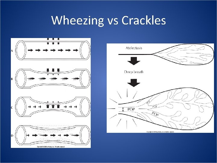 Wheezing vs Crackles 