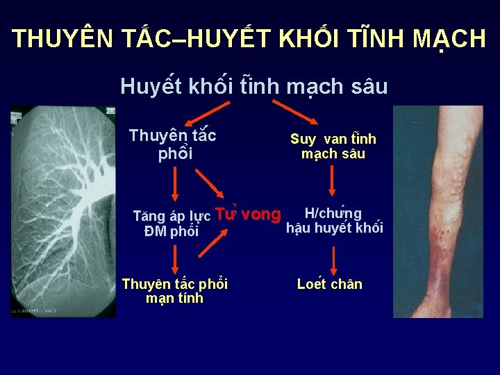 THUYÊN TẮC–HUYẾT KHỐI TĨNH MẠCH Huyê t khô i ti nh ma ch sâu