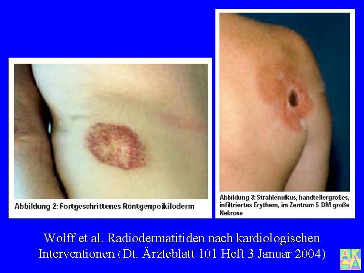 Wolff et al. Radiodermatitiden nach kardiologischen Interventionen (Dt. Ärzteblatt 101 Heft 3 Januar 2004)