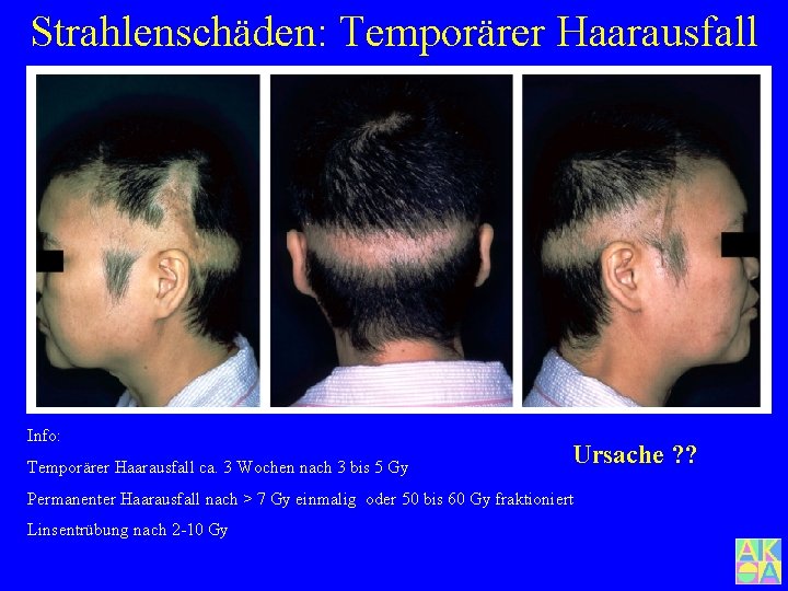 Strahlenschäden: Temporärer Haarausfall Info: Temporärer Haarausfall ca. 3 Wochen nach 3 bis 5 Gy
