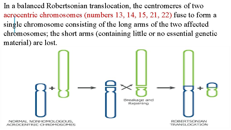 In a balanced Robertsonian translocation, the centromeres of two acrocentric chromosomes (numbers 13, 14, In a balanced Robertsonian translocation, the centromeres of two acrocentric chromosomes (numbers 13, 14,
