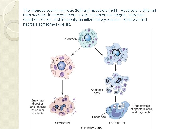 The changes seen in necrosis (left) and apoptosis (right). Apoptosis is different from necrosis.