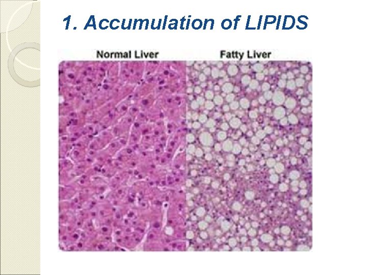 1. Accumulation of LIPIDS 