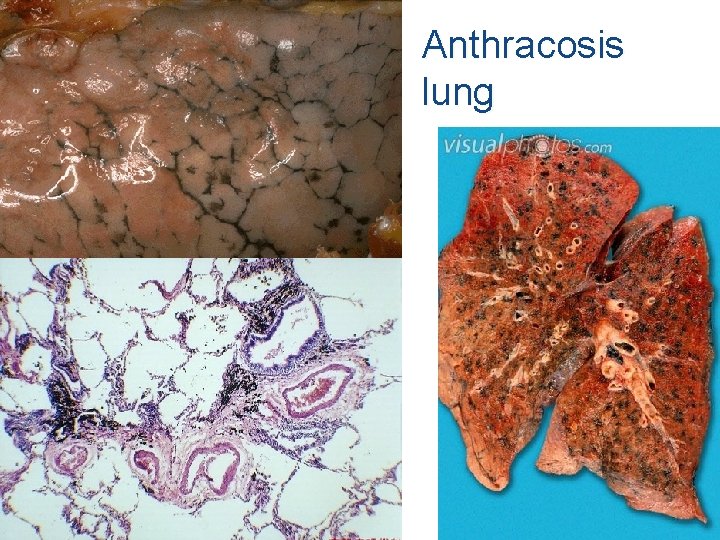 Anthracosis lung 