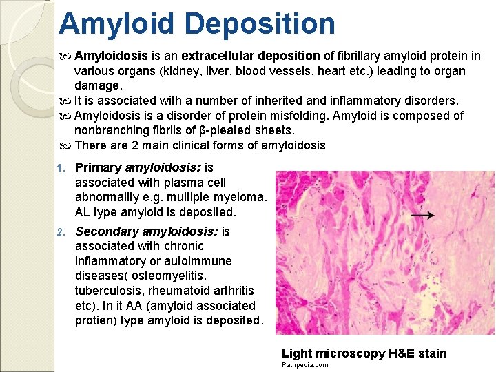 Amyloid Deposition Amyloidosis is an extracellular deposition of fibrillary amyloid protein in various organs