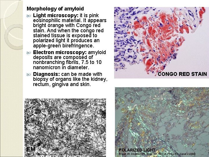 Morphology of amyloid Light microscopy: it is pink eosinophilic material. It appears bright orange