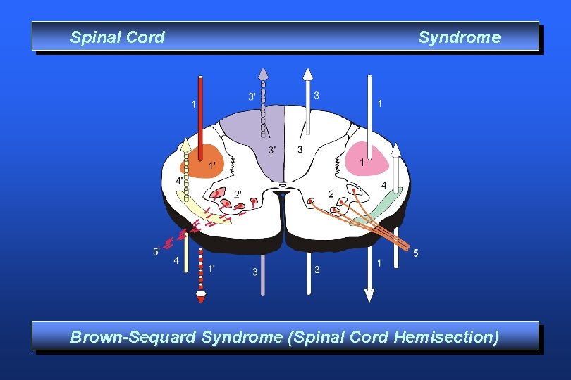 Spinal Cord Syndrome Brown-Sequard Syndrome (Spinal Cord Hemisection) 