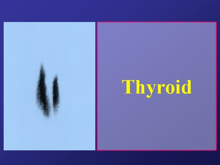 Thyroid Thyroid