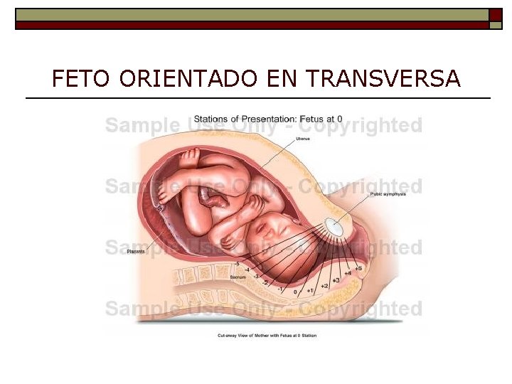 FETO ORIENTADO EN TRANSVERSA 