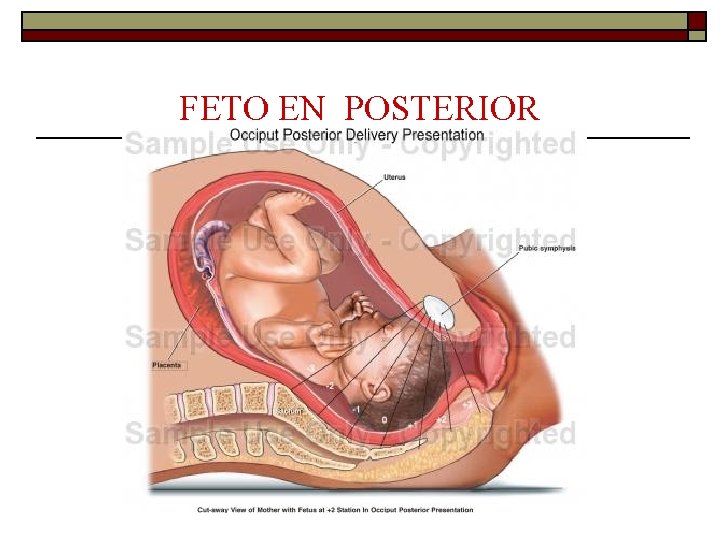 FETO EN POSTERIOR 