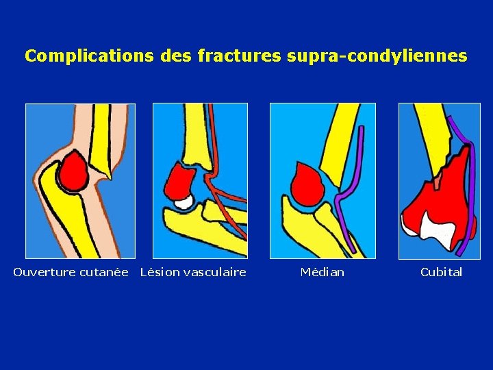 Complications des fractures supra-condyliennes Ouverture cutanée Lésion vasculaire Médian Cubital 