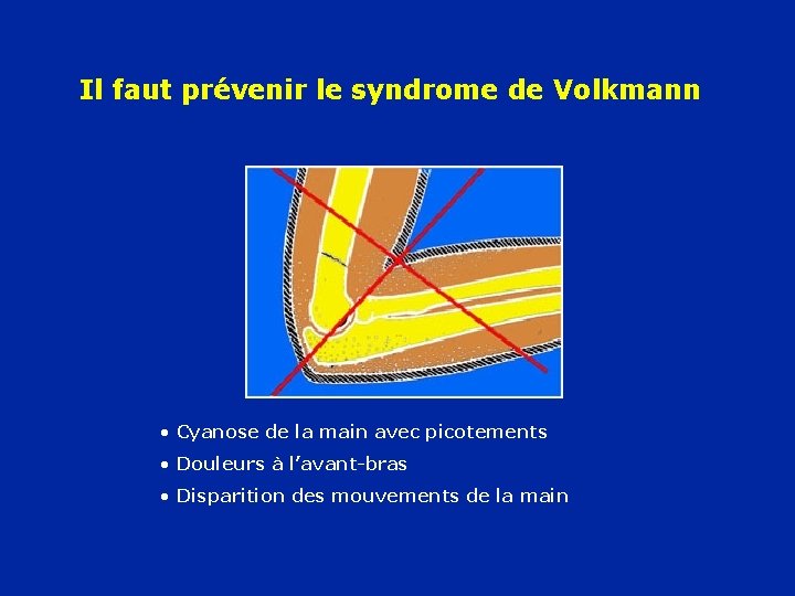 Il faut prévenir le syndrome de Volkmann • Cyanose de la main avec picotements