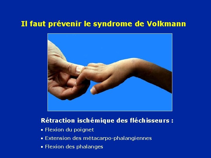 Il faut prévenir le syndrome de Volkmann Rétraction ischémique des fléchisseurs : • Flexion