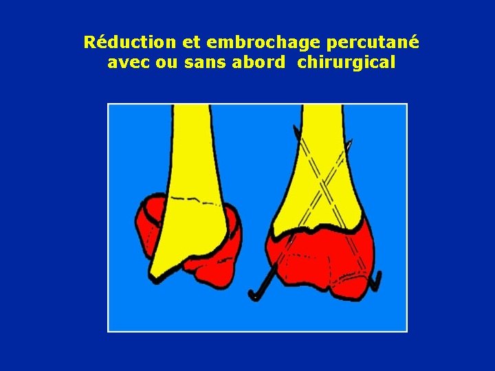 Réduction et embrochage percutané avec ou sans abord chirurgical 