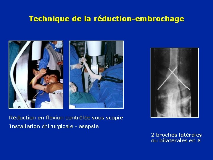 Technique de la réduction-embrochage Réduction en flexion contrôlée sous scopie Installation chirurgicale - asepsie