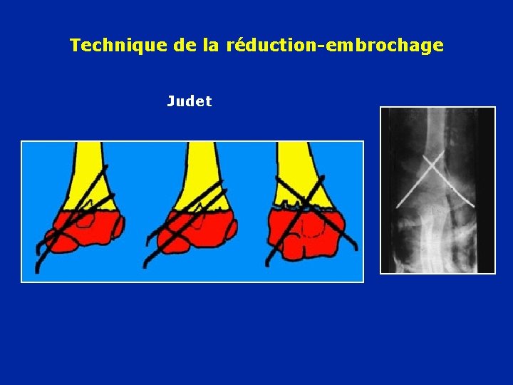 Technique de la réduction-embrochage Judet 