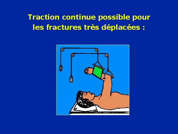 Traction continue possible pour les fractures très déplacées : 