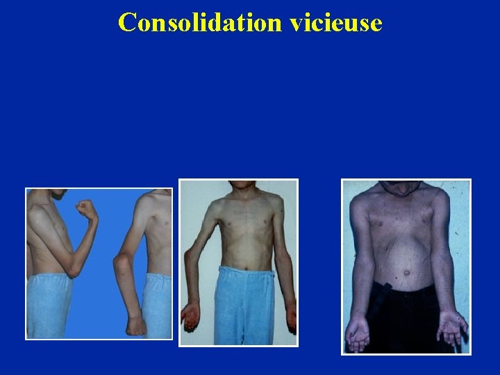 Consolidation vicieuse 