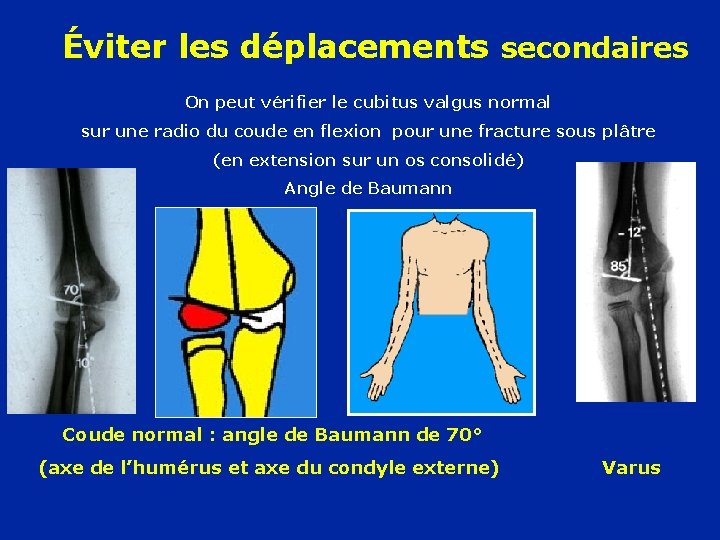 Éviter les déplacements secondaires On peut vérifier le cubitus valgus normal sur une radio