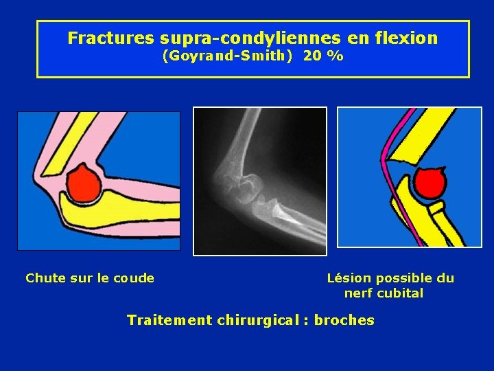 Fractures supra-condyliennes en flexion (Goyrand-Smith) 20 % Chute sur le coude Lésion possible du