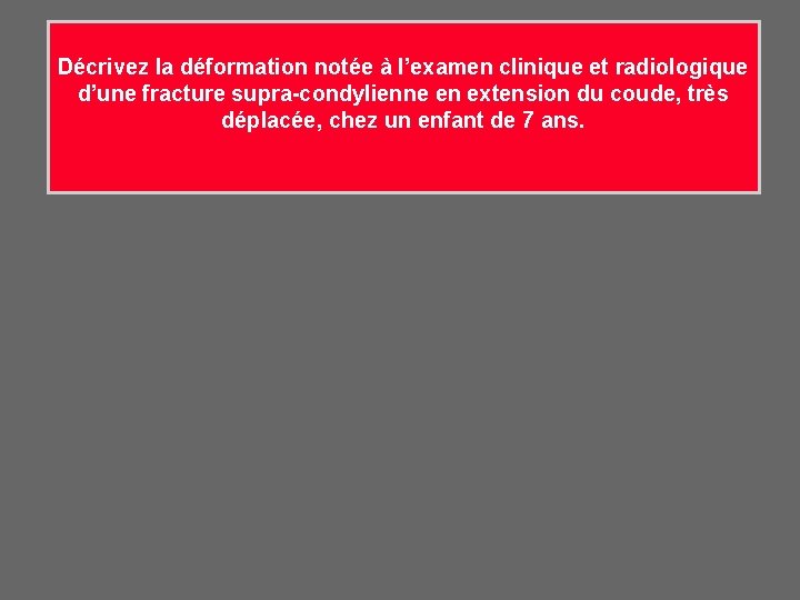 Décrivez la déformation notée à l’examen clinique et radiologique d’une fracture supra-condylienne en extension