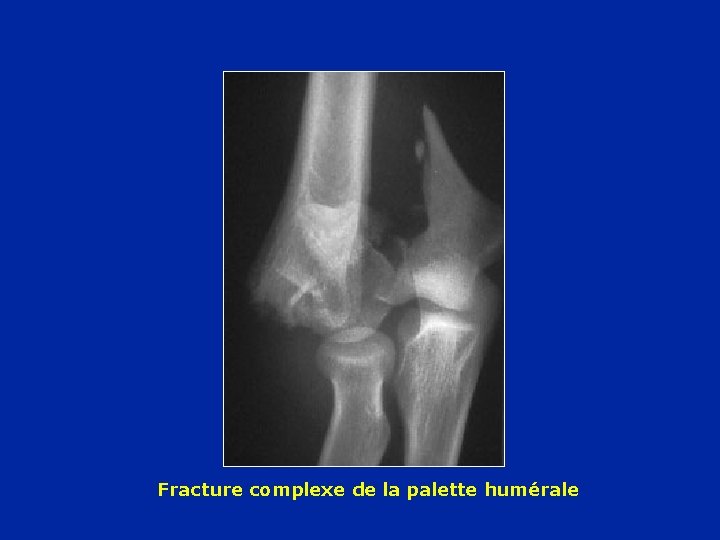Fracture complexe de la palette humérale 