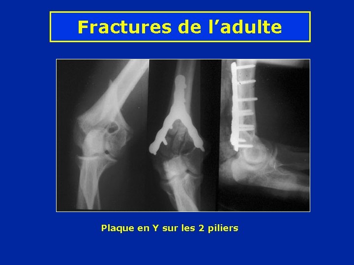 Fractures de l’adulte Plaque en Y sur les 2 piliers 