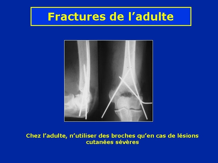 Fractures de l’adulte Chez l’adulte, n’utiliser des broches qu’en cas de lésions cutanées sévères