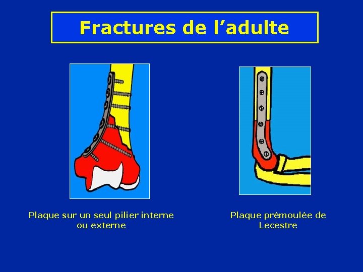 Fractures de l’adulte Plaque sur un seul pilier interne ou externe Plaque prémoulée de