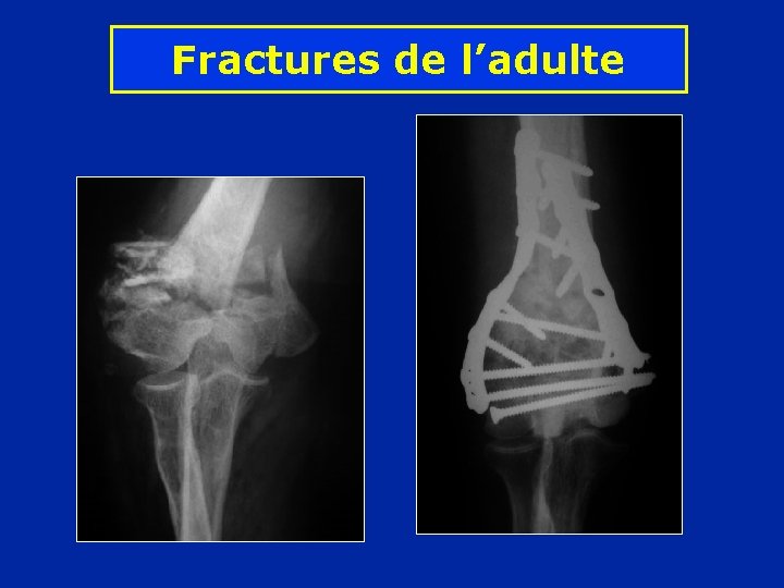 Fractures de l’adulte 