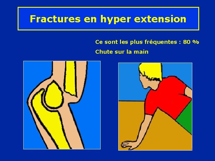 Fractures en hyper extension Ce sont les plus fréquentes : 80 % Chute sur