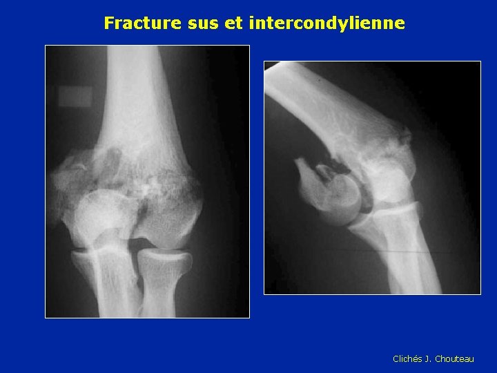 Fracture sus et intercondylienne Clichés J. Chouteau 