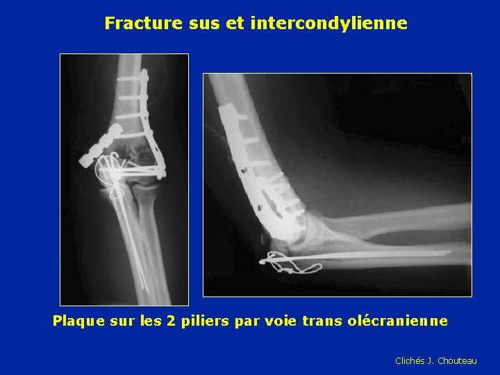 Fracture sus et intercondylienne Plaque sur les 2 piliers par voie trans olécranienne Clichés